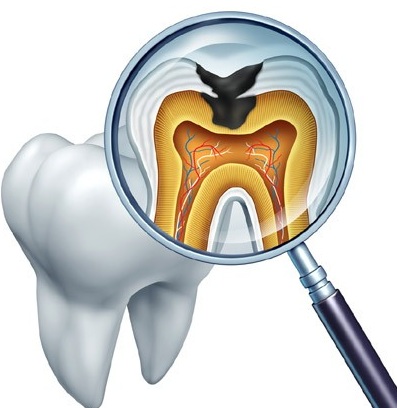 حقایقی درباره پوسیدگی دندان