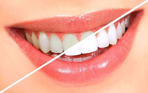 سفیدکننده های طبیعی دندان