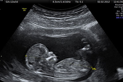 سونوگرافی آنومالی چیست و در کدام هفته از بارداری انجام می شود؟